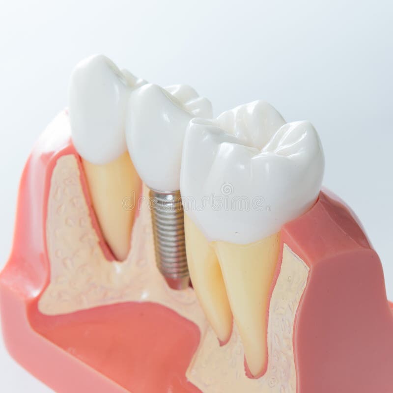 Innesto dentale immagine stock Innesto dentale immagine stock