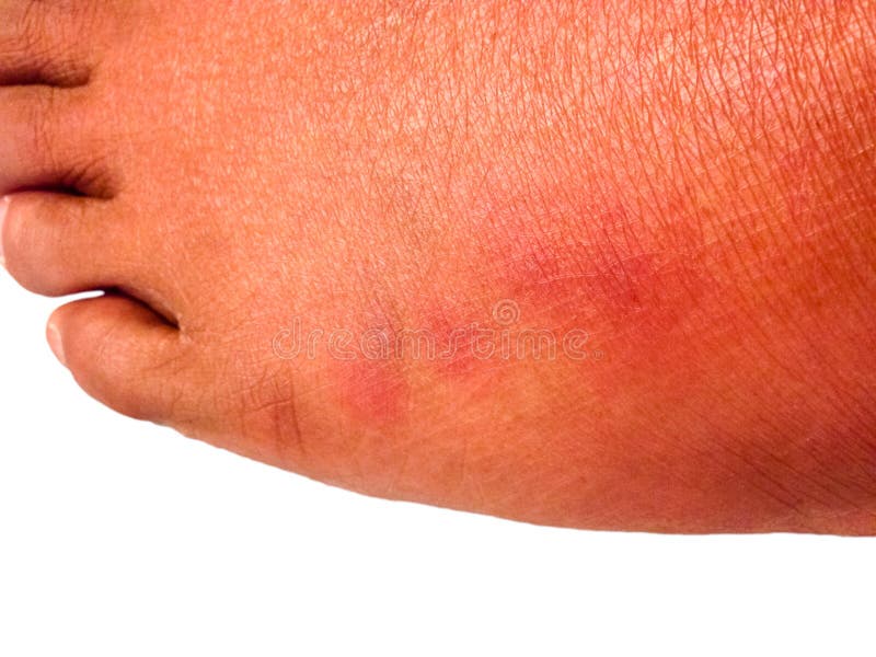 Insect Bites stock photo. Image of cimex, bloodsucker 57960710