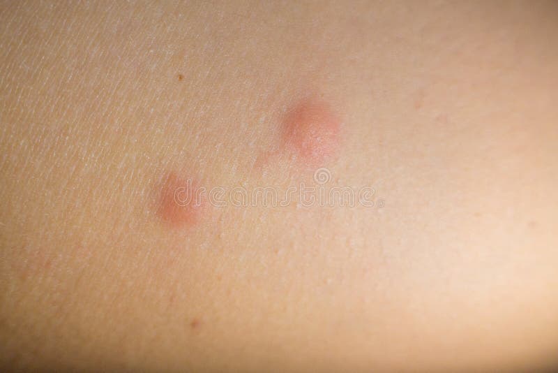 Insect Bites on Female Hand Stock Image Image of rash, disease 134822503