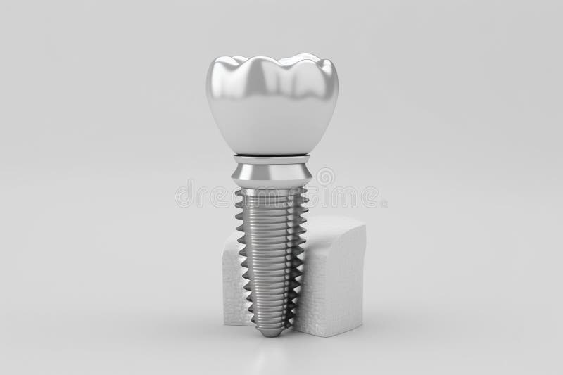 Dental Implan Stock Illustrations 4 Dental Implan Stock Illustrations