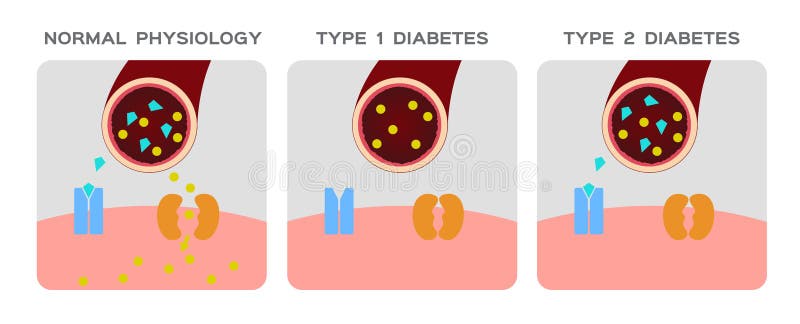 Insulin Type / Normal Physiology , Diabetes / Unlocks the Cell`s Glucose  Channel Animation Graphic Stock Vector - Illustration of diagram,  mechanism: 117578338