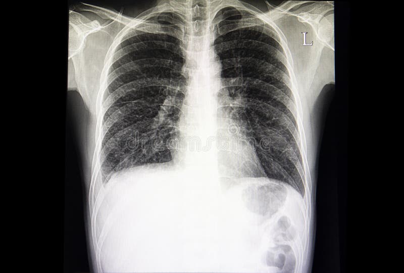 Interstital lung disease with minimal pleural effusion