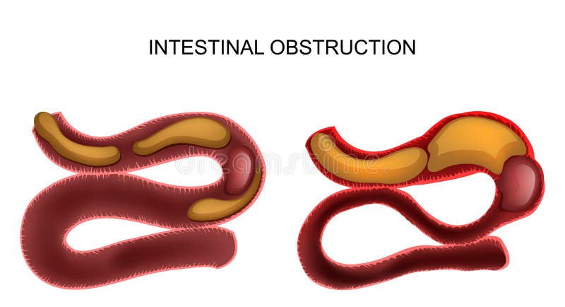 Vector illustration of intestinal obstruction due to a cancerous tumor. Vector illustration of intestinal obstruction due to a cancerous tumor