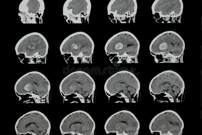 Brain computer tomography & x28;CT& x29; scan of a patient with large intracranial hemorrhage & x28;hemorrhagic stroke& x29; in his left cerebral hemisphere. Brain computer tomography & x28;CT& x29; scan of a patient with large intracranial hemorrhage & x28;hemorrhagic stroke& x29; in his left cerebral hemisphere