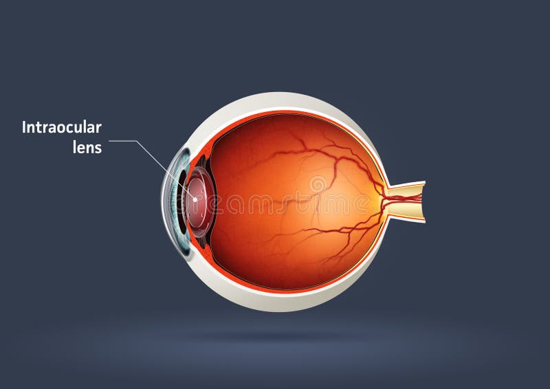 Intraocular lens