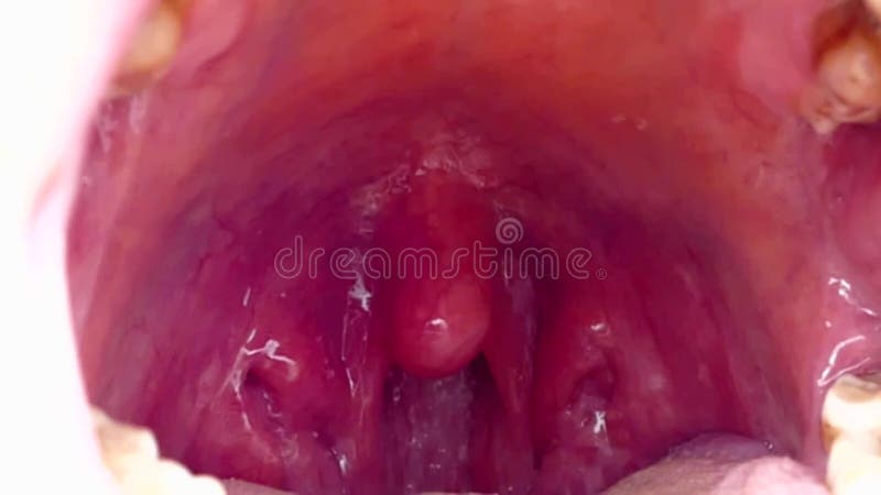 Intraoral tonsil in the mouth, tonsillitis, neglected human mouth