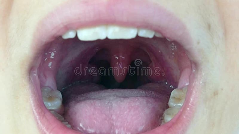 Intraoral tonsil in the mouth, tonsillitis, neglected human mouth