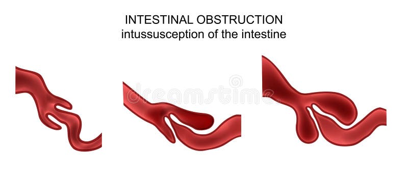Vector illustration of intussusception of intestine. obstruction. Vector illustration of intussusception of intestine. obstruction.