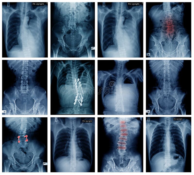 Big collection back and pelvic x-ray, high quality setof x-ray. Big collection back and pelvic x-ray, high quality setof x-ray