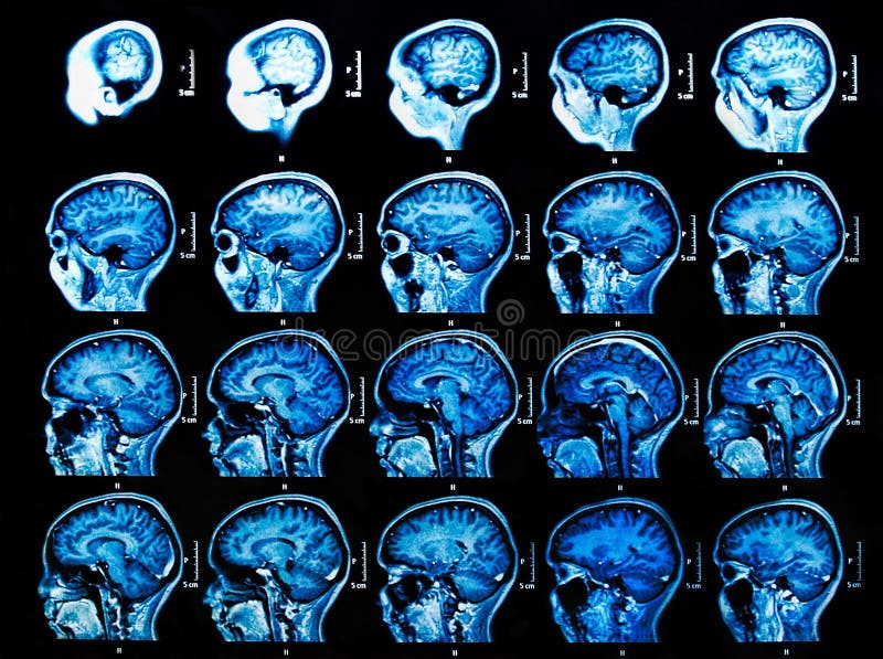 IRM Brain Scan image stock IRM Brain Scan image stock