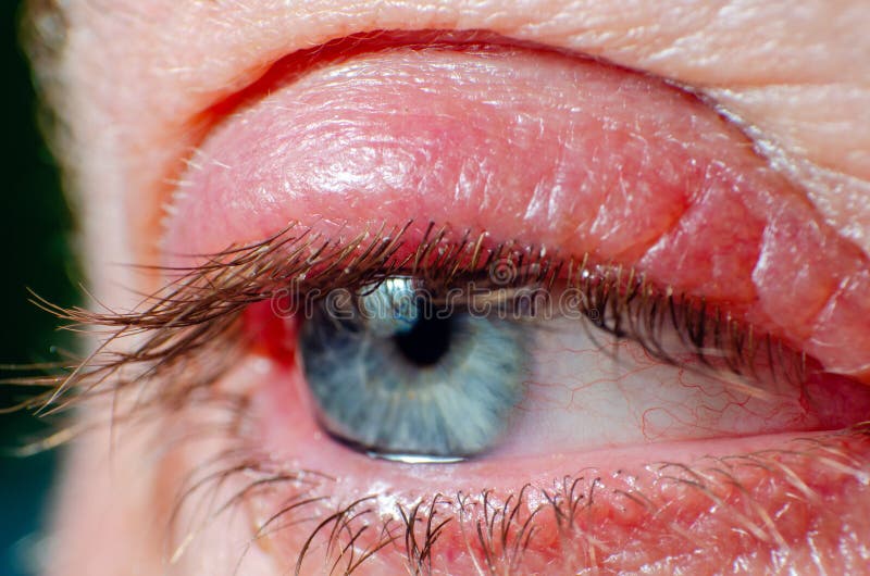 Irritated Red Bloodshot Eye Stock Image Image of infection