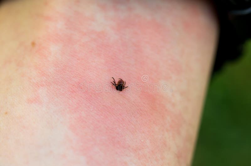 Irritation from the Bite. Redness on the Skin from a Tick Bite. a Dangerous Tick  Bite. Stock Photo - Image of borreliose, flea: 118070490