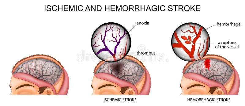 Ischemic And Hemorrhagic Stroke Stock Vector Illustration Of Ischemia Ischaemia 99236625