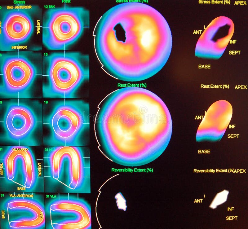 Nuclear medicine stress test reveals ischemia in the septal part of heart on stress images ,which are in the upper part of picture,black spots which not present in rest phase images (lower part). Nuclear medicine stress test reveals ischemia in the septal part of heart on stress images ,which are in the upper part of picture,black spots which not present in rest phase images (lower part)