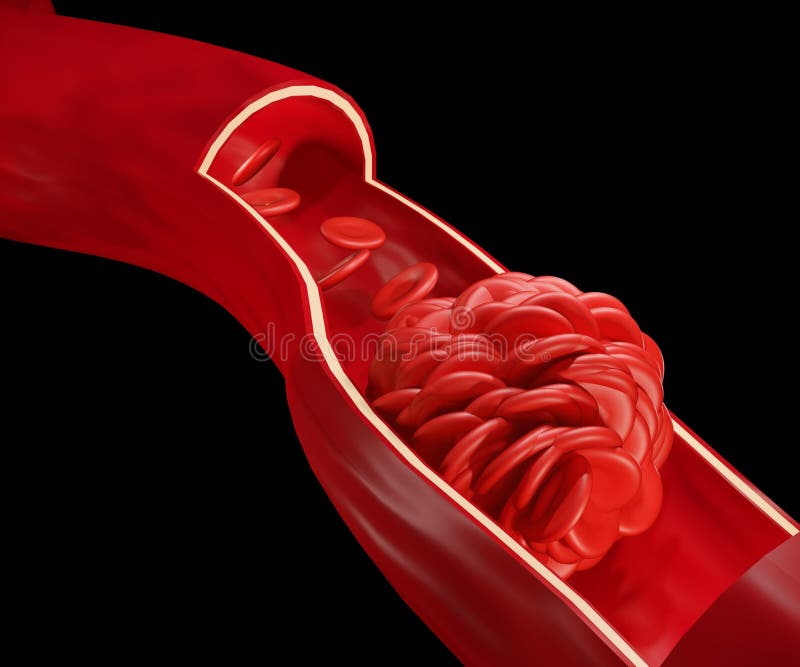 Blood Clot or Thrombus is the Final Product of the Blood Coagulation Step in Hemostasis Stock Illustration - Illustration of medical, disease: 245441453 Blood Clot or Thrombus is the Final Product of the Blood Coagulation Step in Hemostasis Stock Illustration - Illustration of medical, disease: 245441453