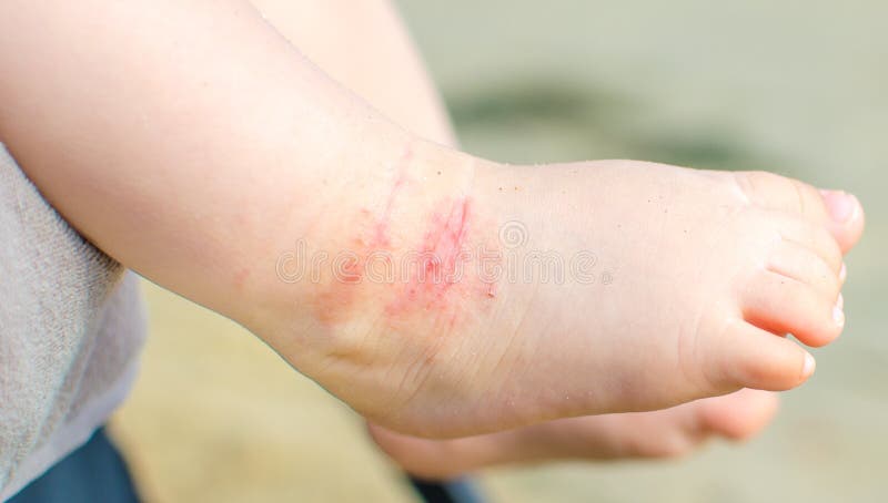 Itchy dermatitis atopic baby foot