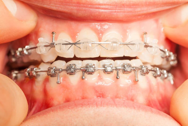 Jaw with Braces Installed on Teeth Closeup View Stock Photo Image of