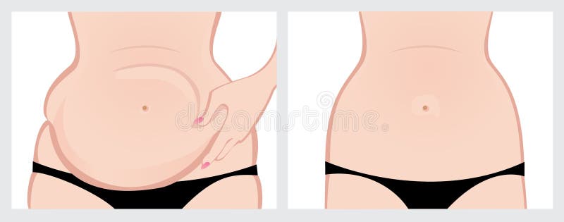 Jelly Belly, before and after. Stock Vector - Illustration of operation,  belly: 31784657
