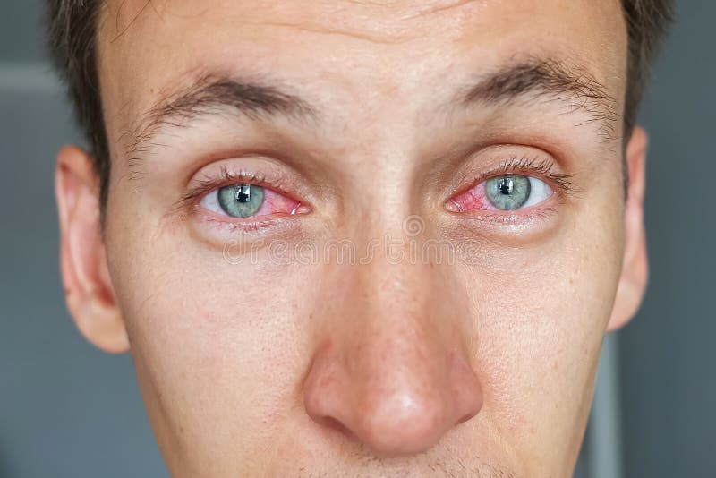 toewijzen Verlaten eten Jonge man met rode ogen stock afbeelding. Image of allergie - 224814495