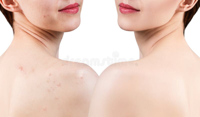 Jonge vrouw met acne op schouders before and after behandeling stock afbeelding Jonge vrouw met acne op schouders before and after behandeling stock afbeelding