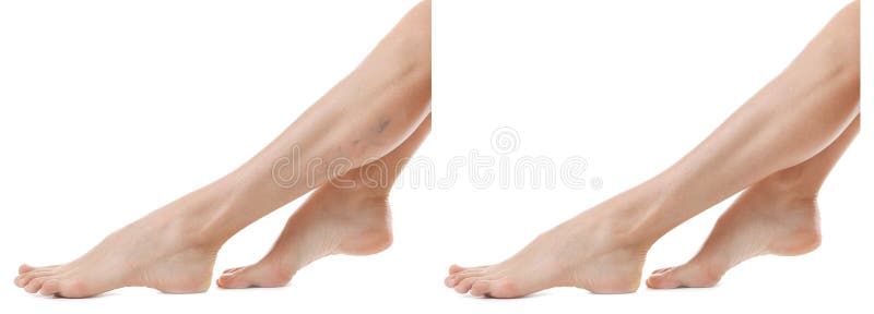 Jonge vrouw voor en na behandeling van spataderen stock fotografie