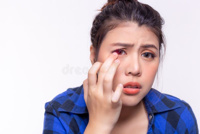 Olhos Irritados De Uma Menina Que Ficasse Doente Com Conjuntivite Foto de  Stock - Imagem de adolescente, inchado: 146506816