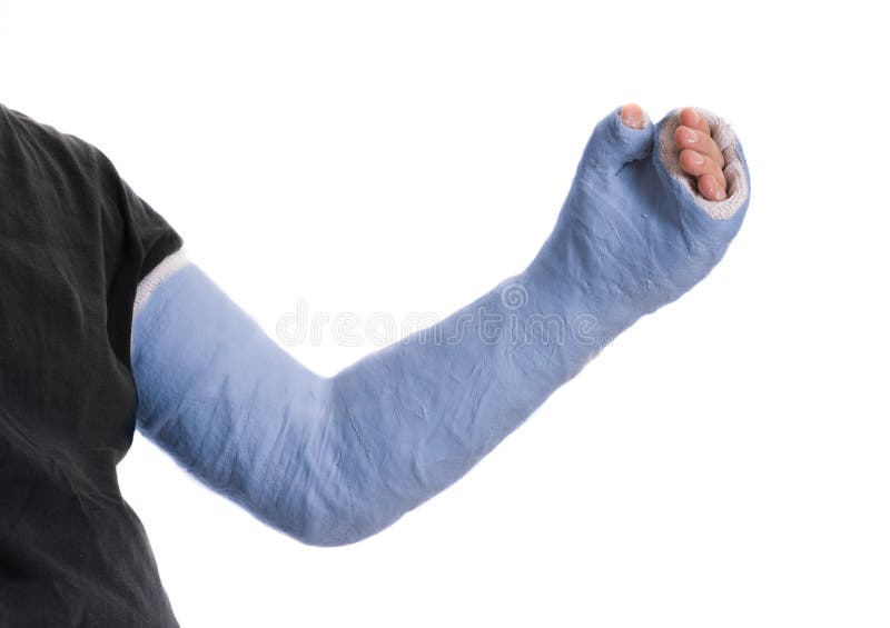 Close up of a young man`s blue long arm plaster / fiberglass cast covering the wrist, arm, and elbow after an accident, isolated on white. Close up of a young man`s blue long arm plaster / fiberglass cast covering the wrist, arm, and elbow after an accident, isolated on white