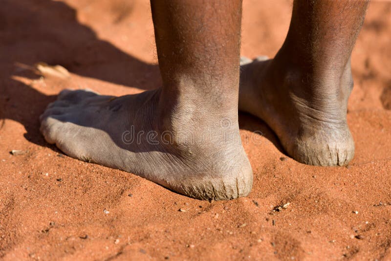 Illustration Of Healthy Feet And Feet With Cracks On The Heel Royalty Free  SVG, Cliparts, Vectors, and Stock Illustration. Image 61123618.