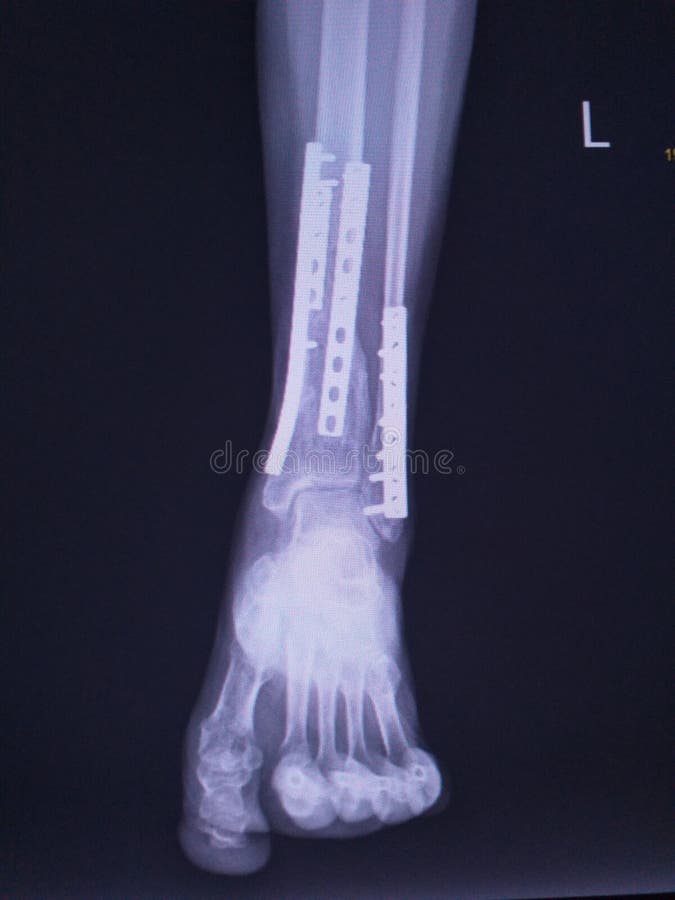 File:Enchondrom Tibia 83jm - Roe ap und seitlich - 001.jpg - Wikimedia  Commons