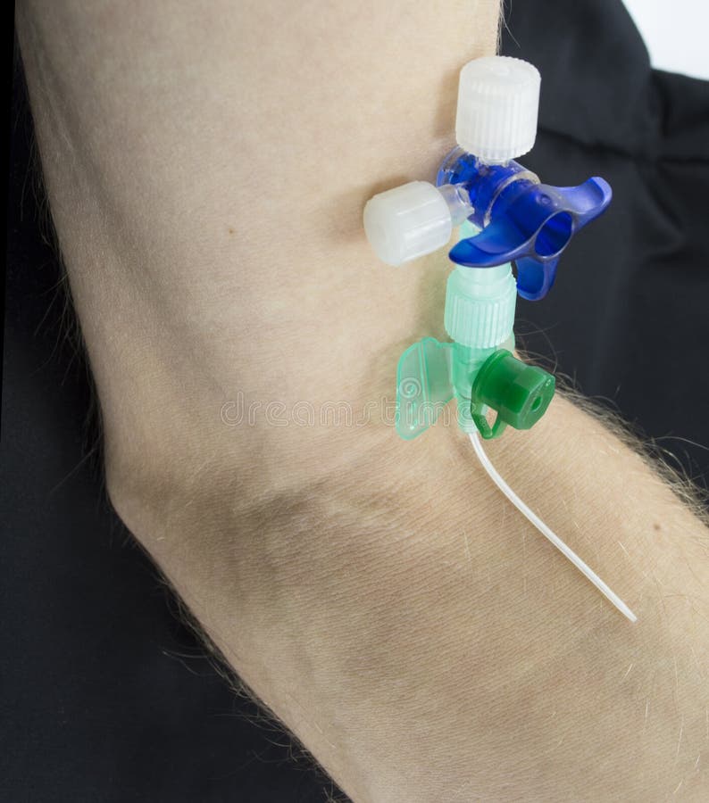Der Katheter an Hand stockbild. Bild von hand, katheter 48194171
