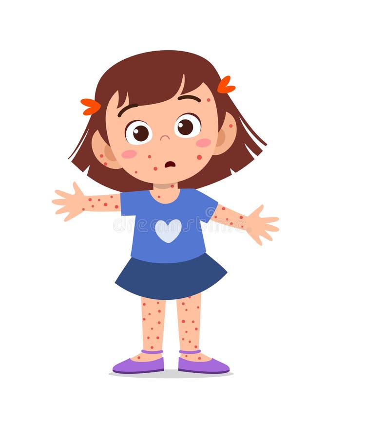 Chicken Pox Stock Illustrations – 599 Chicken Pox Stock Illustrations, Vectors & Clipart - Dreamstime Chicken Pox Stock Illustrations – 599 Chicken Pox Stock Illustrations, Vectors & Clipart - Dreamstime