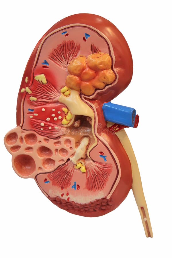 Model of kidney with diseases