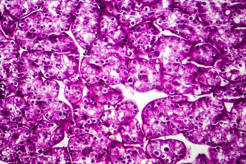 Kidney cancer, light micrograph stock photography