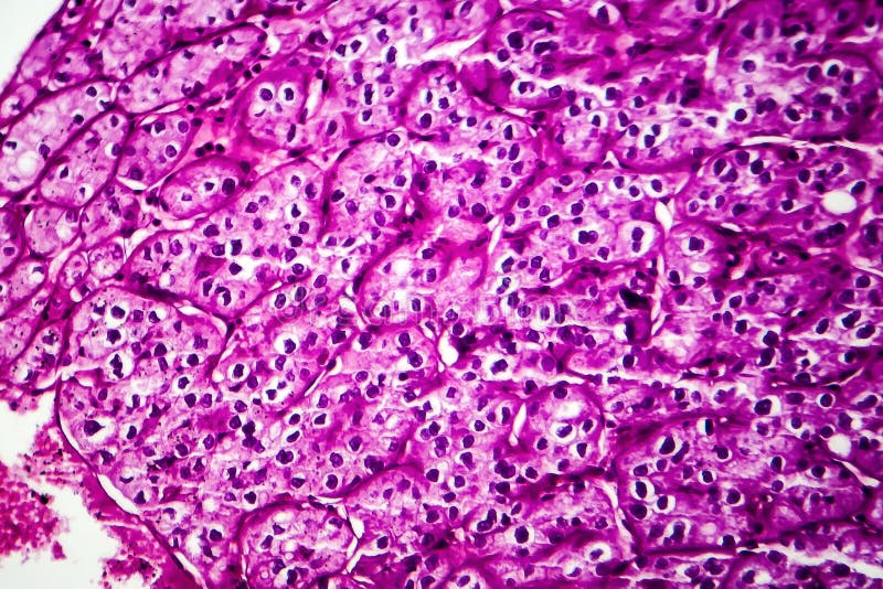 Kidney cancer, light micrograph, photo under microscope, renal, tumor, oncology, malignant, neoplasm, carcinoma, disease, genitourinary, histology, photomicrograph, microscopic, pathology, hematoxylin, eosin, stain, medical, medicine, microscopy, magnification, microphotograph, tissue, cell, morphology, morphological, histopathology