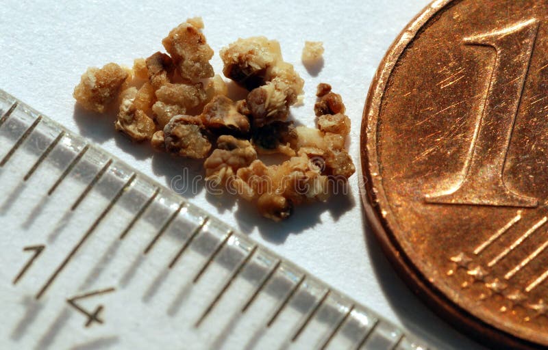 Kidney stones in size compared with cents and Ruler