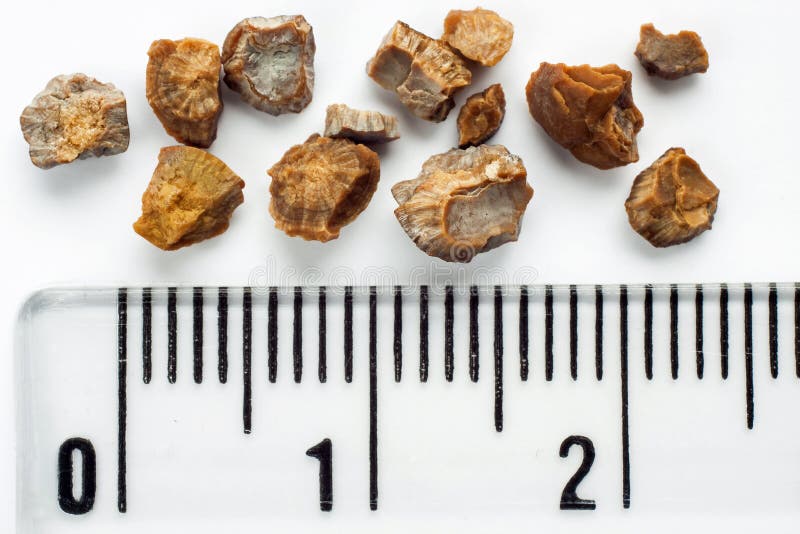 Kidney stones after ESWL intervention. Lithotripsy. Scale in centimeters