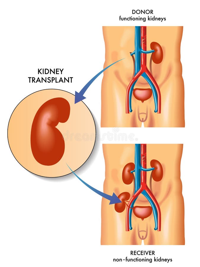 Médico ilustraciones de rinón trasplantar.