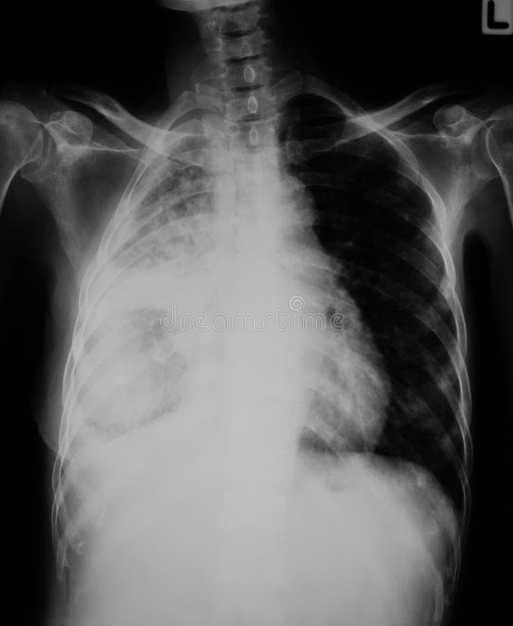 Klatki piersiowej promieniowania rentgenowskiego wizerunek, PA pionowy widok