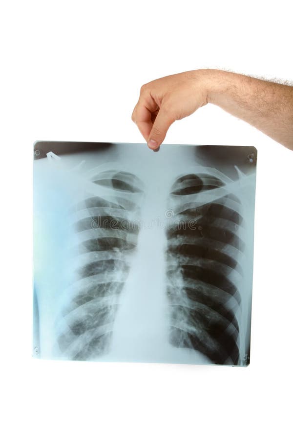 klatki piersiowej xray zdjęcia stock klatki piersiowej xray zdjęcia stock