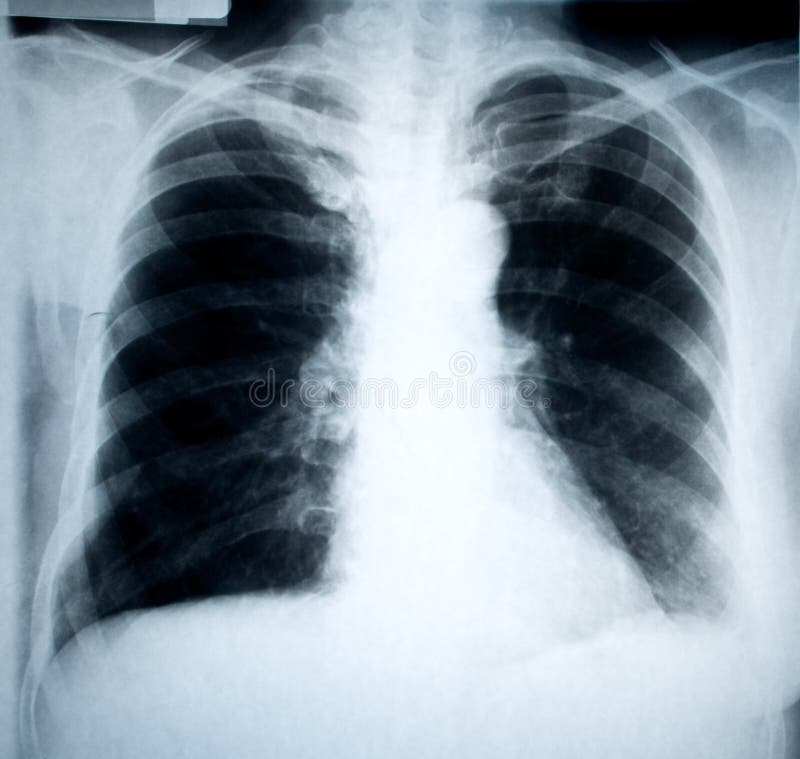 klatki piersiowej xray obraz royalty free klatki piersiowej xray obraz royalty free