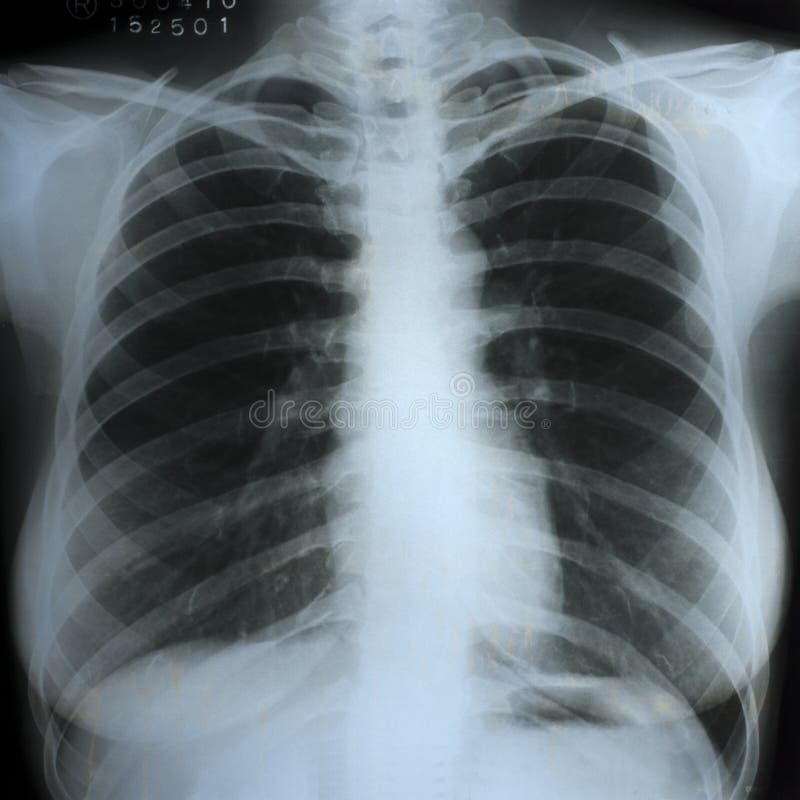 Klatki piersiowej xray obraz cyfrowy zdjęcia stock Klatki piersiowej xray obraz cyfrowy zdjęcia stock