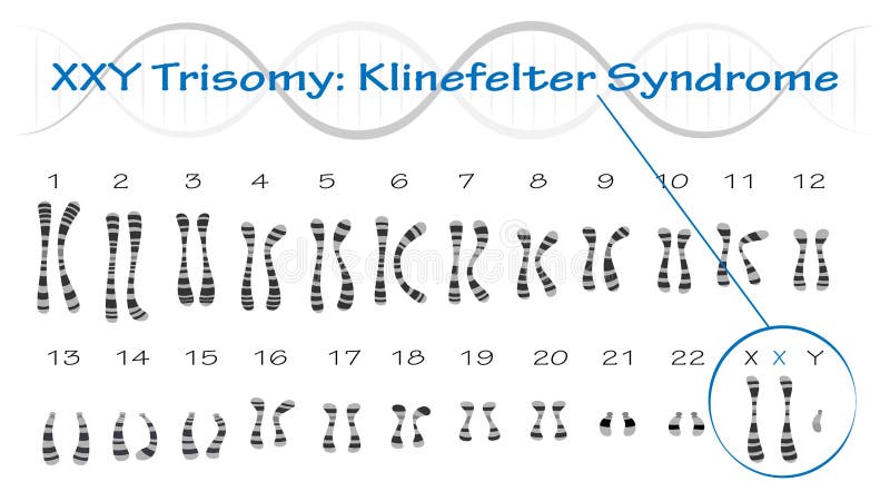 Klinefelter Syndrome Stock Illustrations – 12 Klinefelter Syndrome ...
