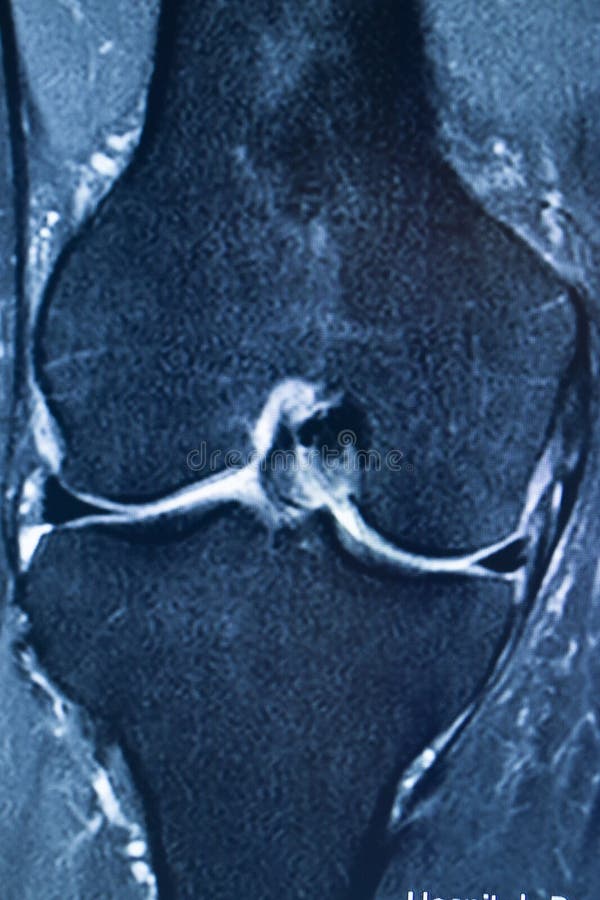 Knee injury mri mcl tear stock image. Image of resonance - 154117387