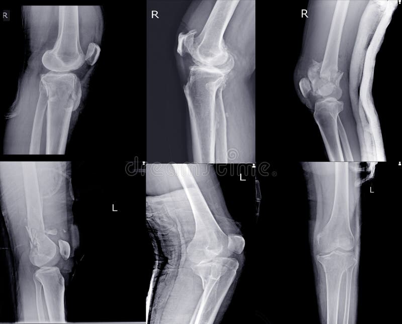 Knee joint x-ray collection fracture different views royalty free stock pho...