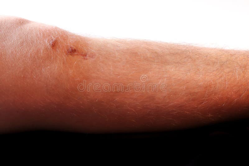 659 Knee Scar Photos Free Royalty Free Stock Photos From Dreamstime 659 Knee Scar Photos Free Royalty Free Stock Photos From Dreamstime