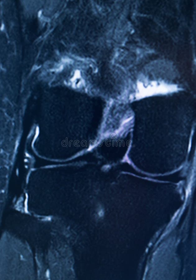 Knee injury mri mcl tear stock image. Image of sports - 154980487