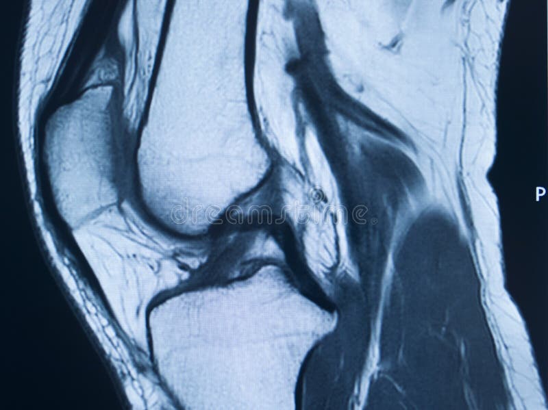 Knee injury mri mcl tear stock photo. Image of patient - 169799088