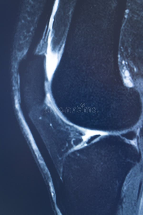 Knee injury mri mcl tear stock image. Image of diagnostic - 172886199