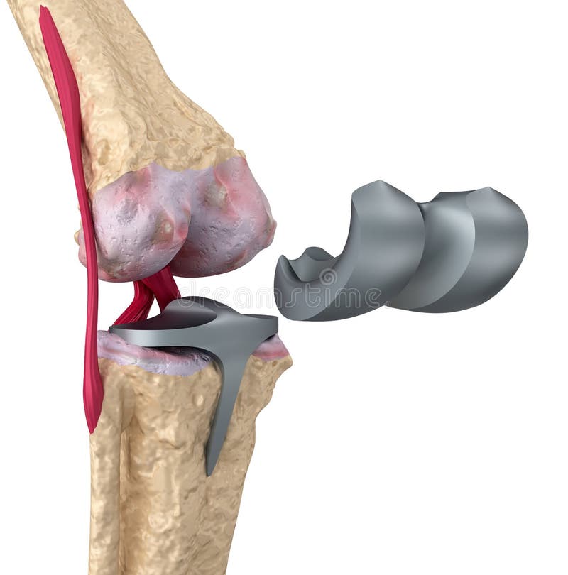 Knee and titanium hinge joint. Isolated royalty free illustration Knee and titanium hinge joint. Isolated royalty free illustration