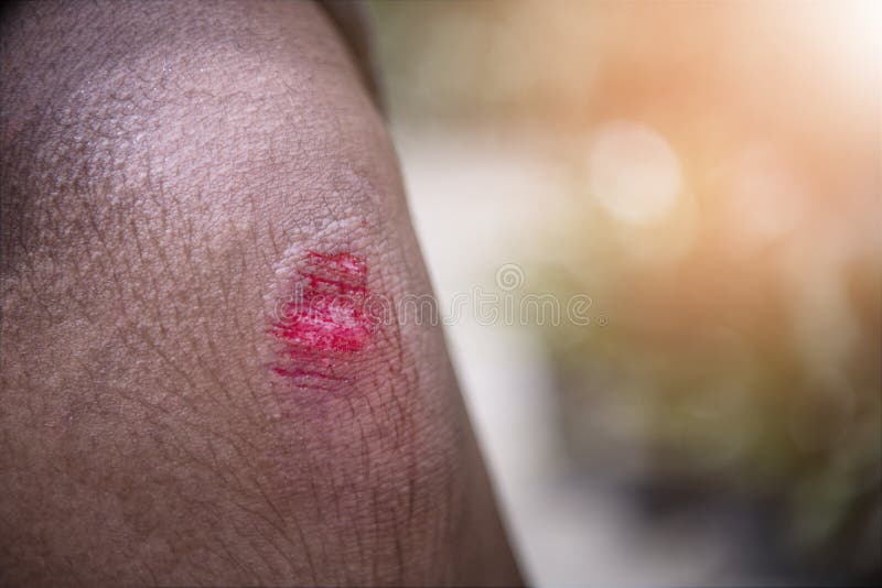 Knee Wound from Fall and Bleeding. Stock Image Image of pain, person